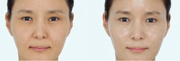 Before and After PLLA topical filler